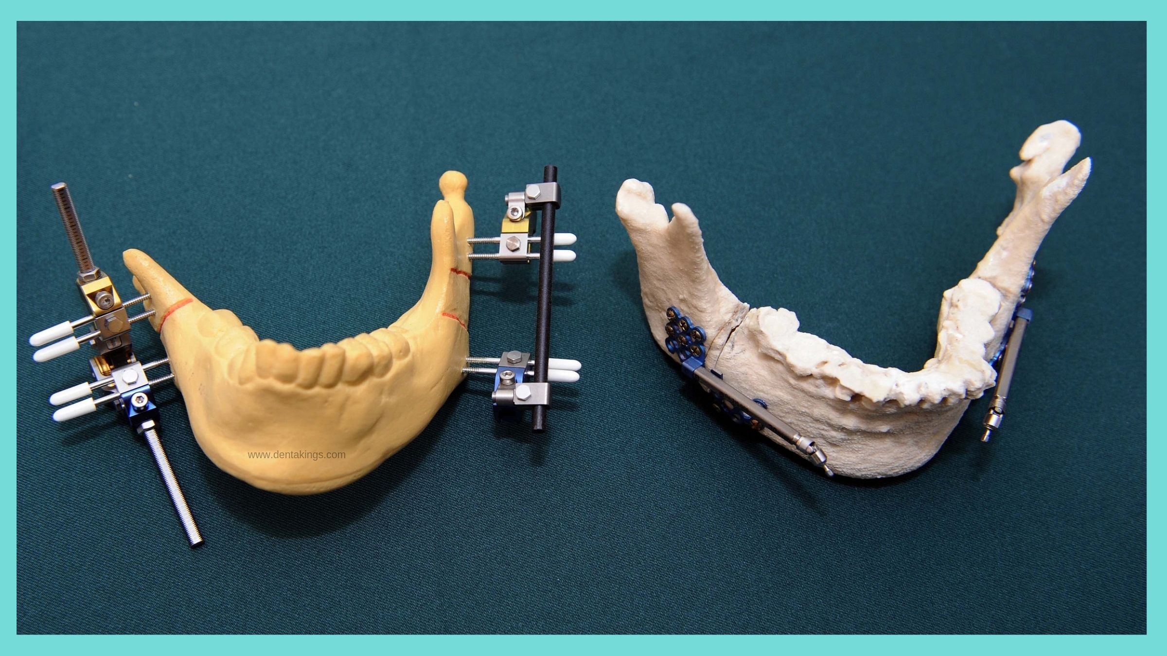 Distraction Osteogenesis Denta Kings