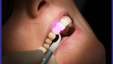 Laser Gum Surgery – LANAP