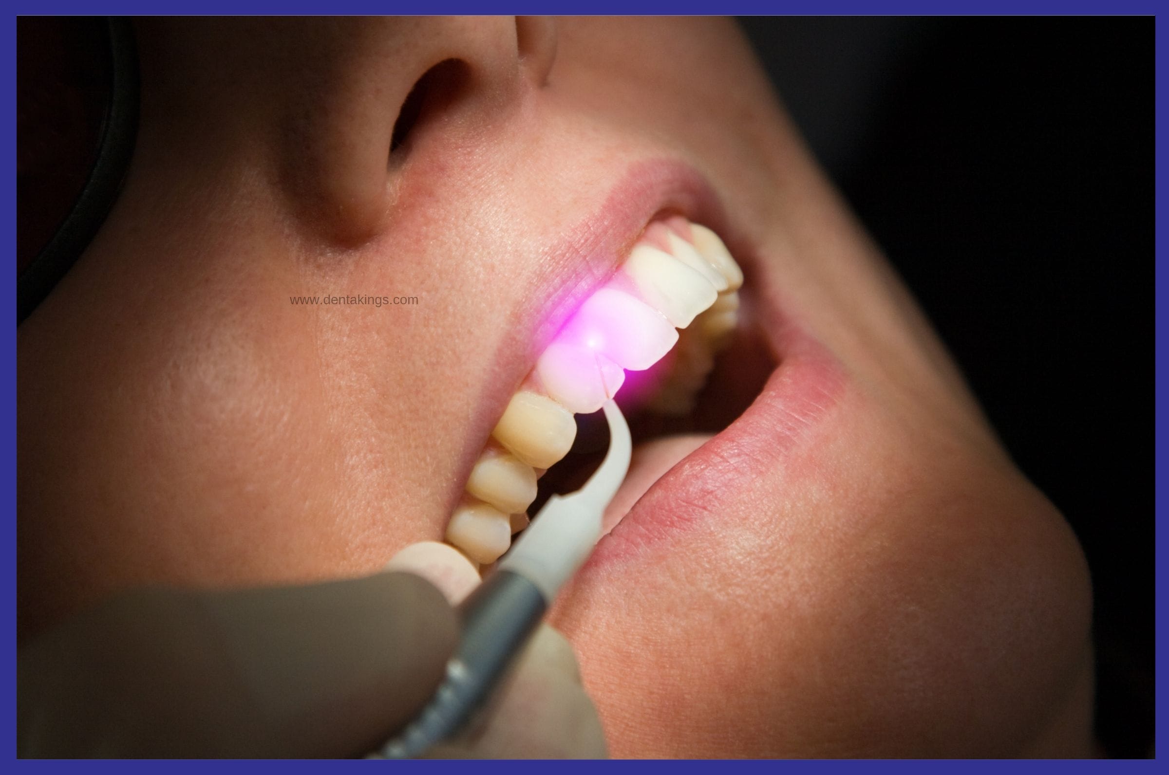 Laser Gum Surgery Cost In Bangalore