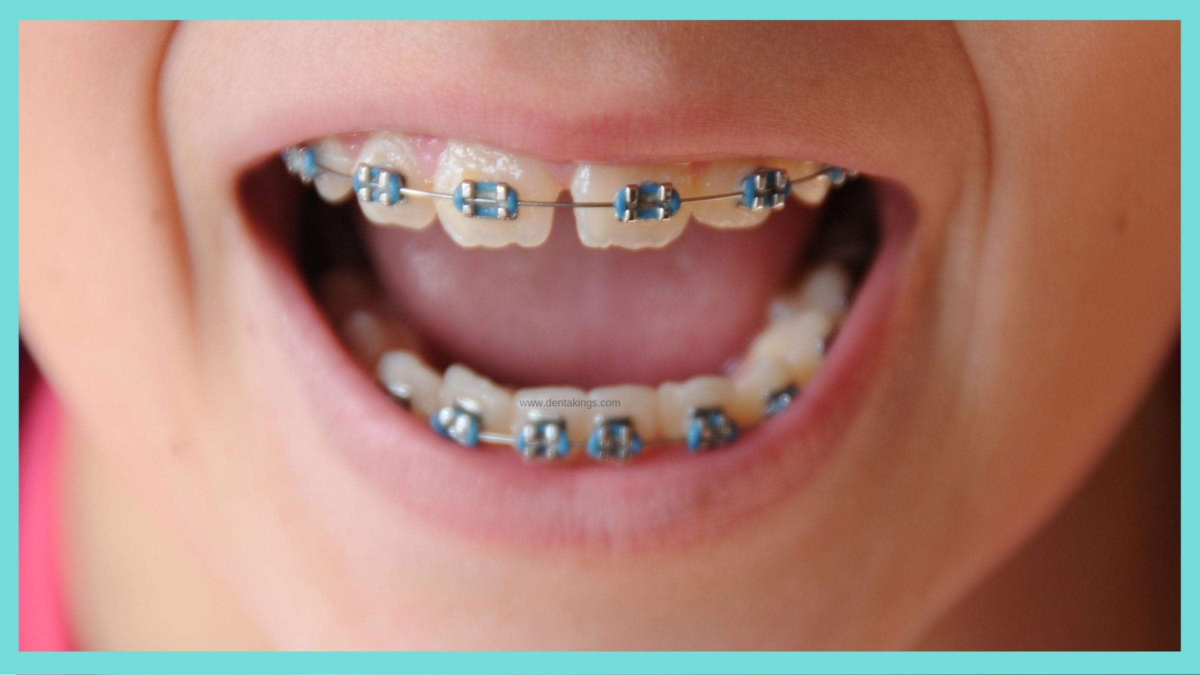 Orthodontic Treatment Denta Kings 5017