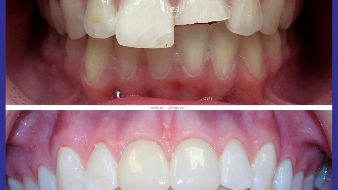 Tooth Color Filling