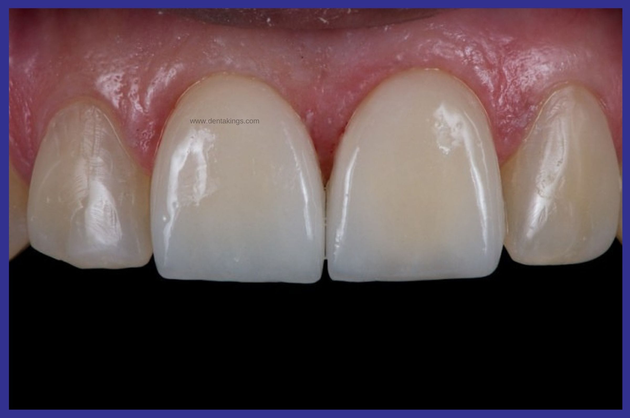 Zirconia Crowns Denta Kings