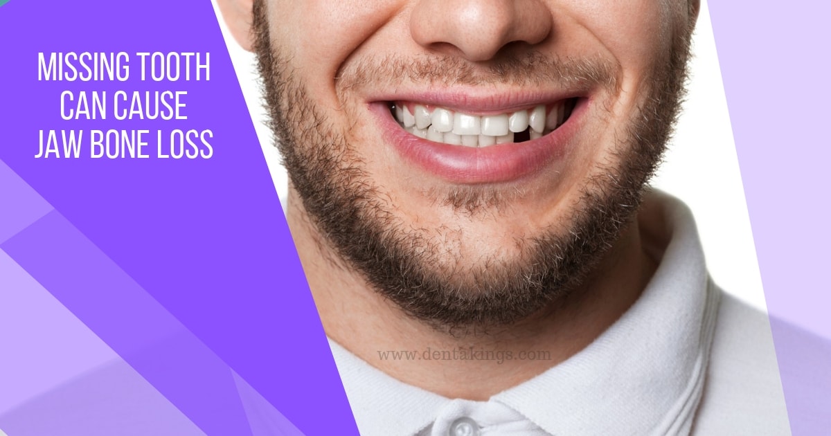 How missing teeth can cause bone loss in the jaw? - Denta Kings