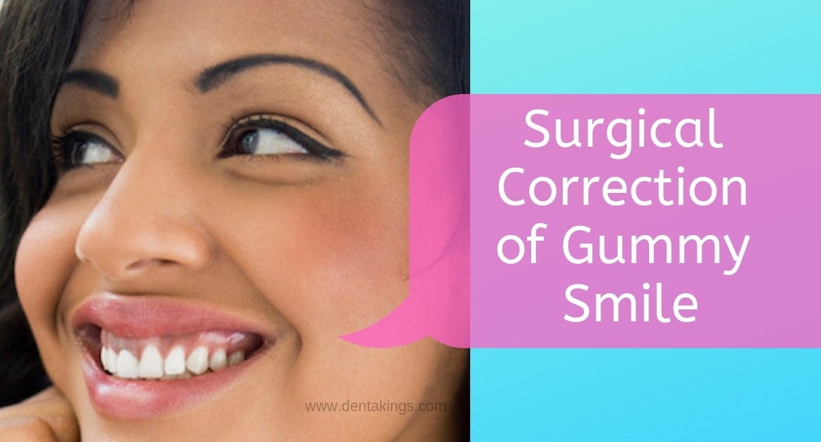 Surgical options for your Gummy Smile