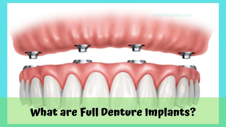 What are Full Denture Implants?