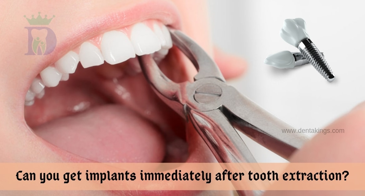 Can you get implants immediately after tooth extraction?