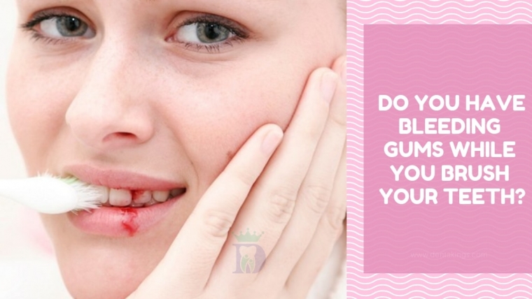 Do you have bleeding gums while you brush your teeth?