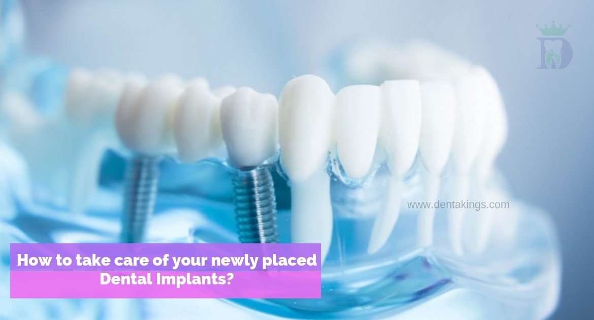 How to Care for your newly placed Dental Implants?