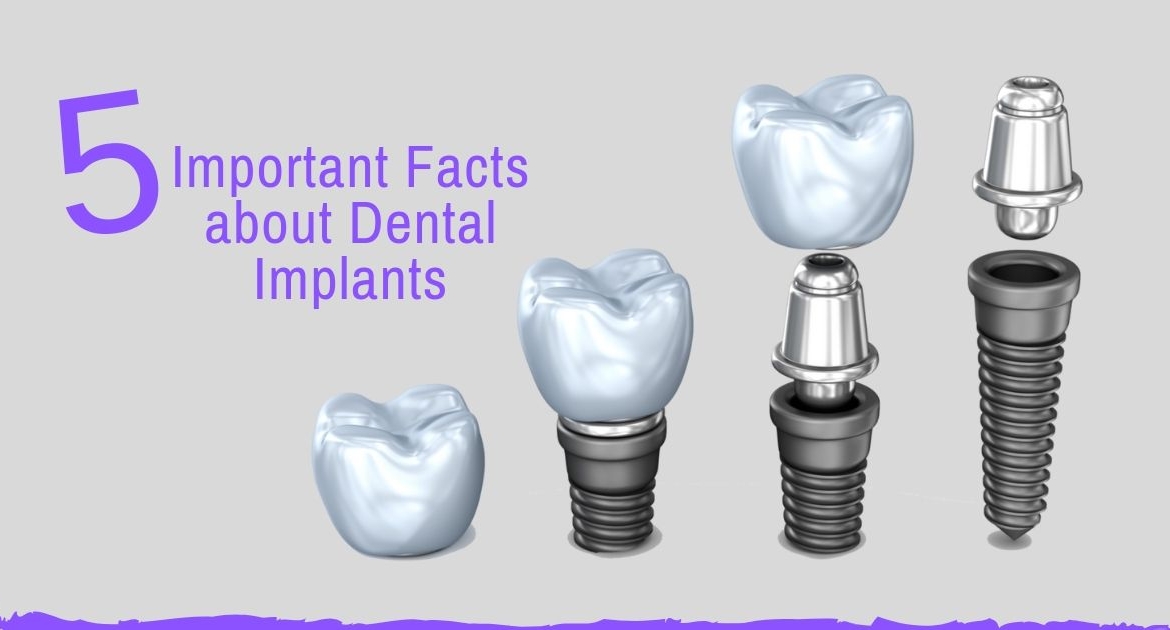 5 Important facts about Dental Implants