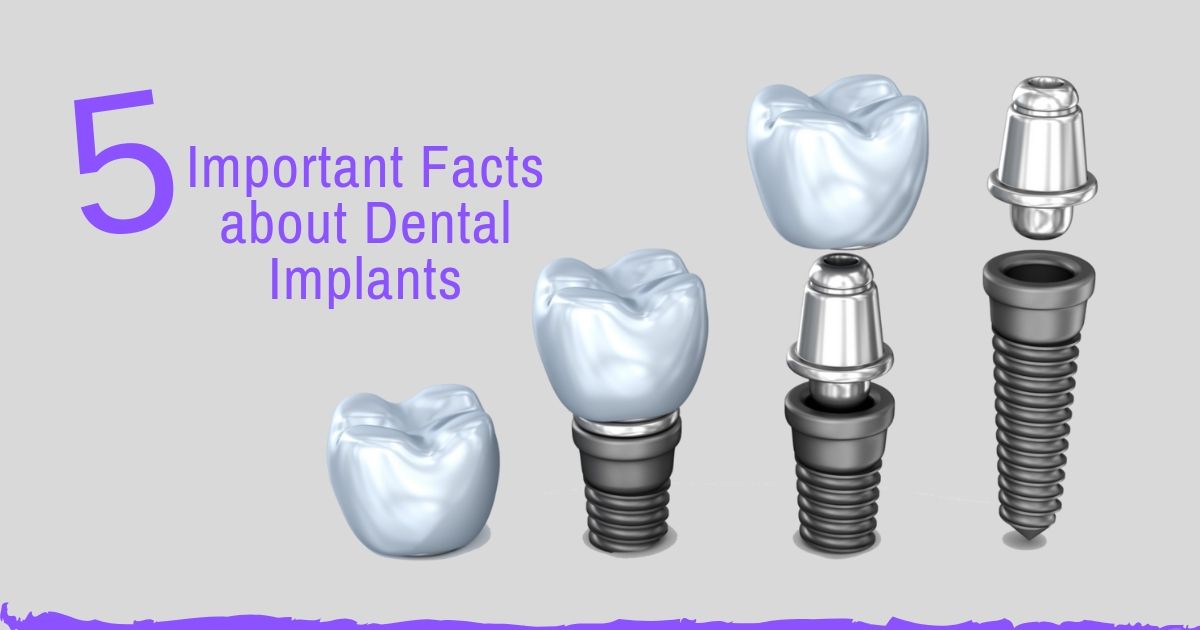 5 Important facts about Dental Implants - Denta Kings