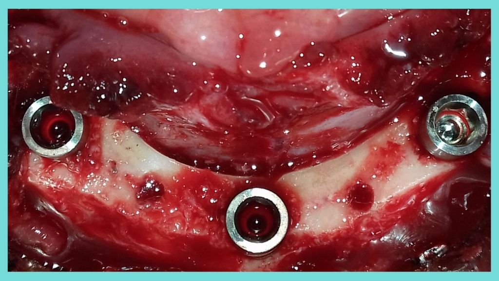 Trefoil Nobel Implant surgery
