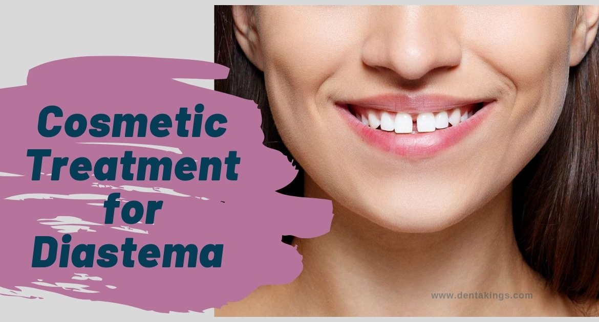Cosmetic Treatment for Diastema