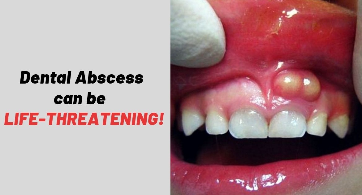Tooth Abscess Swollen Face