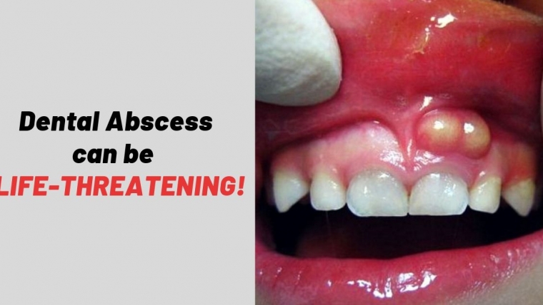 Details on Dental Abscess