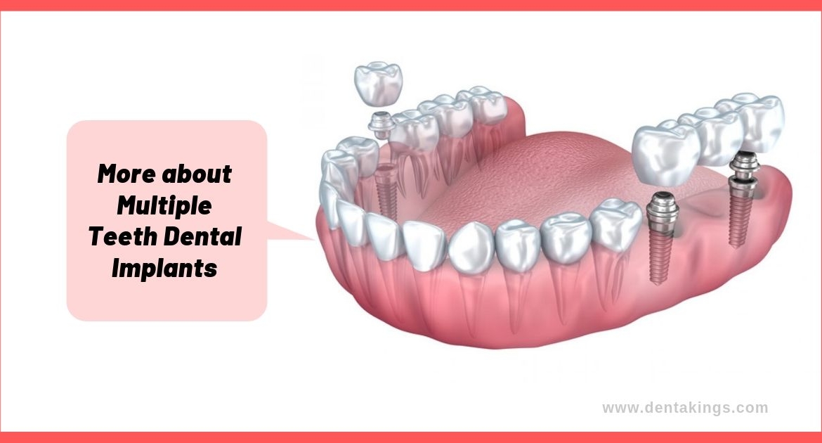 More about Multiple Teeth Dental Implants