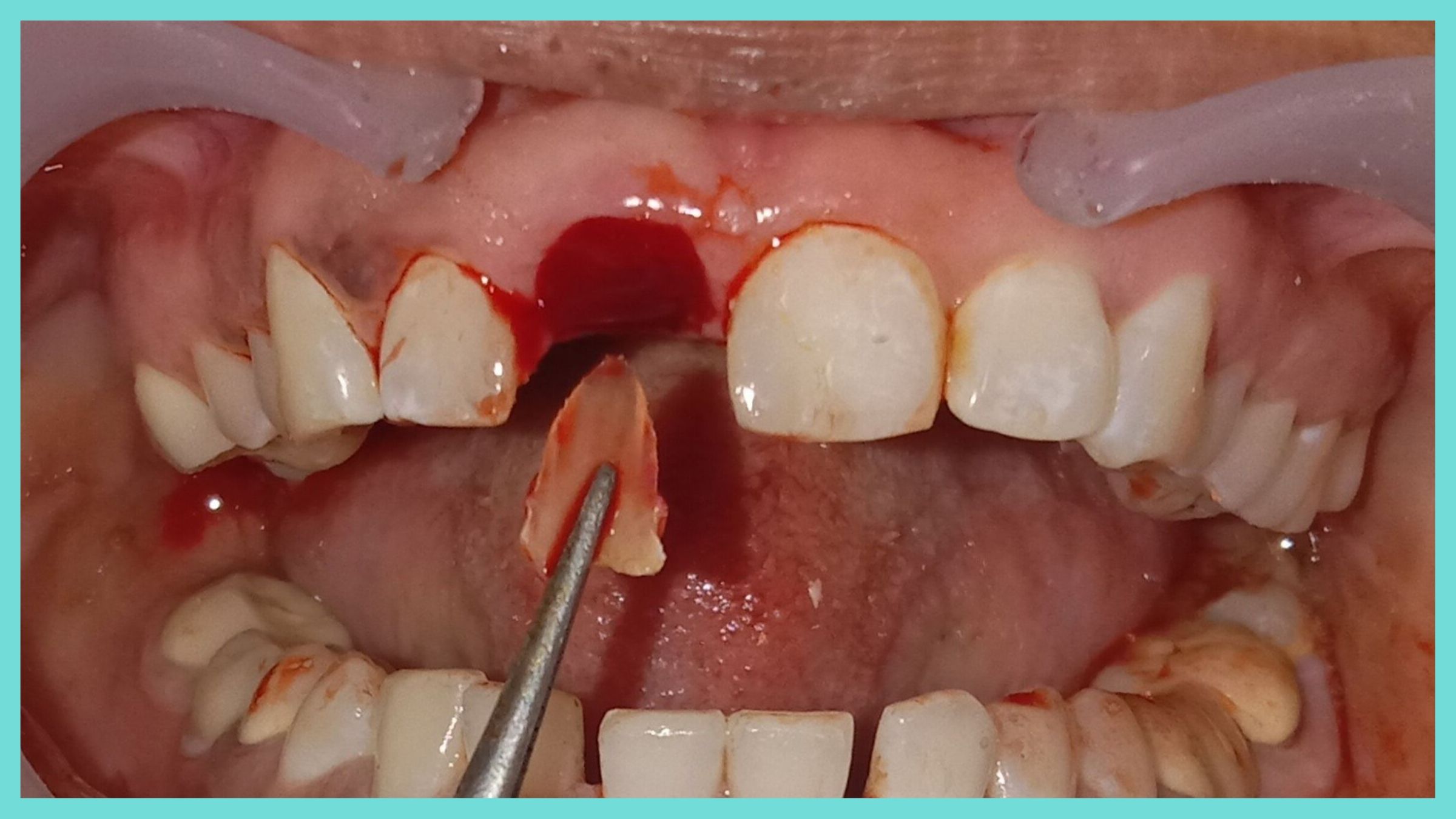 root-membrane-technique-denta-kings