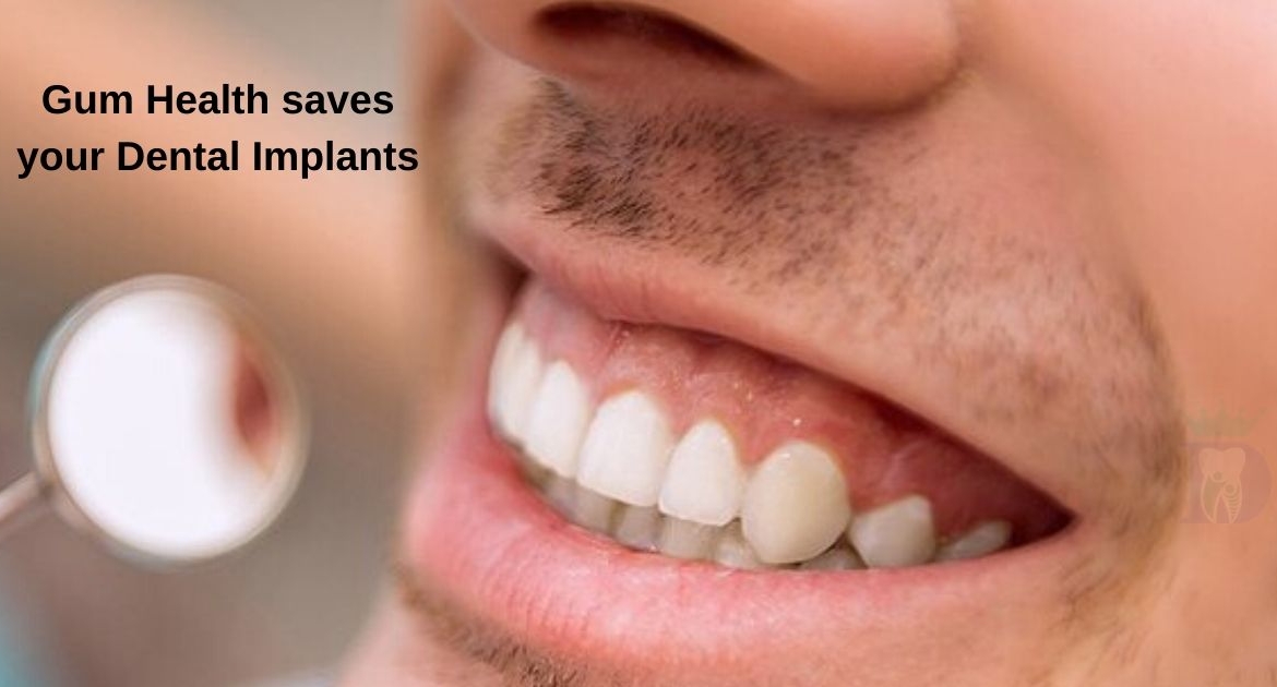 Gum Health saves your Dental Implants