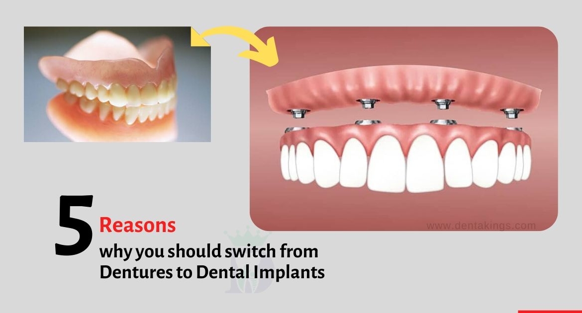5 Reasons why you should switch from Dentures to Dental Implants