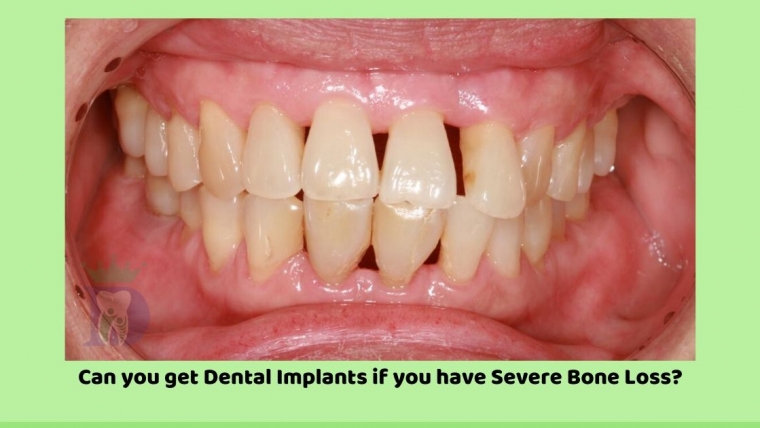 Can you get Dental Implants if you have severe bone loss?
