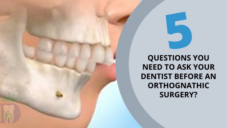 Five questions that you need to ask your Dentist before an Orthognathic Surgery