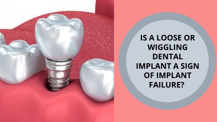 Is a wiggling Dental Implant a sign of Implant failure?
