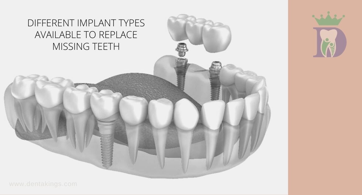 How many Implants you need to replace all your teeth?
