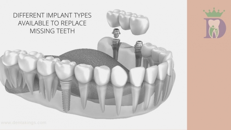 How many Implants you need to replace all your teeth?